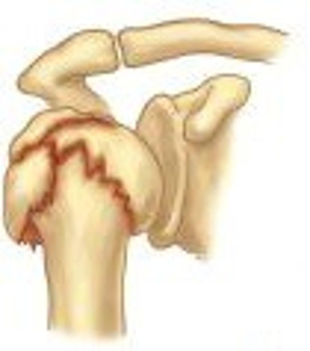 <p>fracture (usually seen in long bones) where broken bone ends are forced into each other</p>