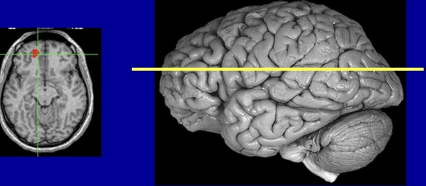 <p>What type of plane/slice of the brain is this</p>
