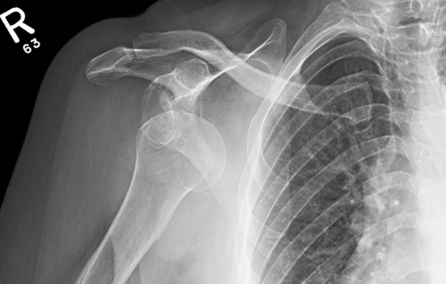<p>- Anterior is the most common</p><p>- Subluxation: the 2 aren't fully separated</p><p>- dislocation: the 2 are fully separated</p>