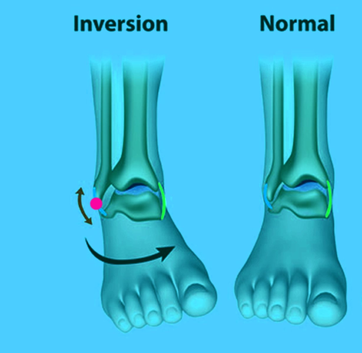 <p>Movement of sole of foot inward</p>
