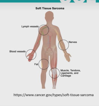 <ul><li><p>bone or soft tissue- 89%</p></li><li><p>soft tissue: nerve, blood vessels, lymph vessels, muscle, tendons, ligaments, cartilage</p></li><li><p>peaks in adolescents during growth spurt</p></li><li><p>not common - 5,300 each year</p></li></ul><p></p>