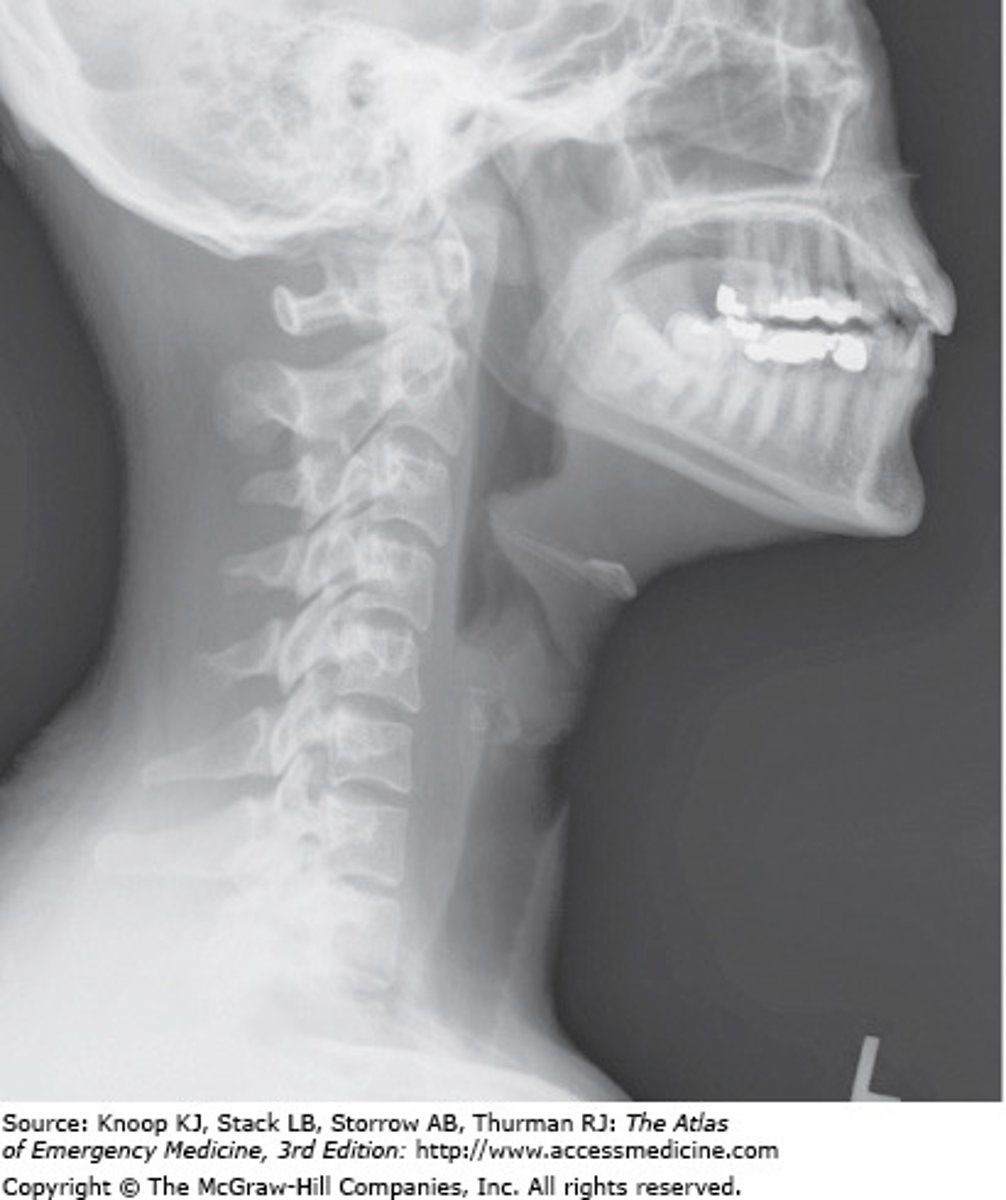 <p>The Correct Answer is: B</p><p>This case of acute epiglottitis is treated with immediate intravenous steroids. Provided that the patient is able to maintain the airway and also keep oxygen saturation rates above 92%, the patient can improve with steroids and supportive care. Antiviral medications have little effect on the overall illness.</p>