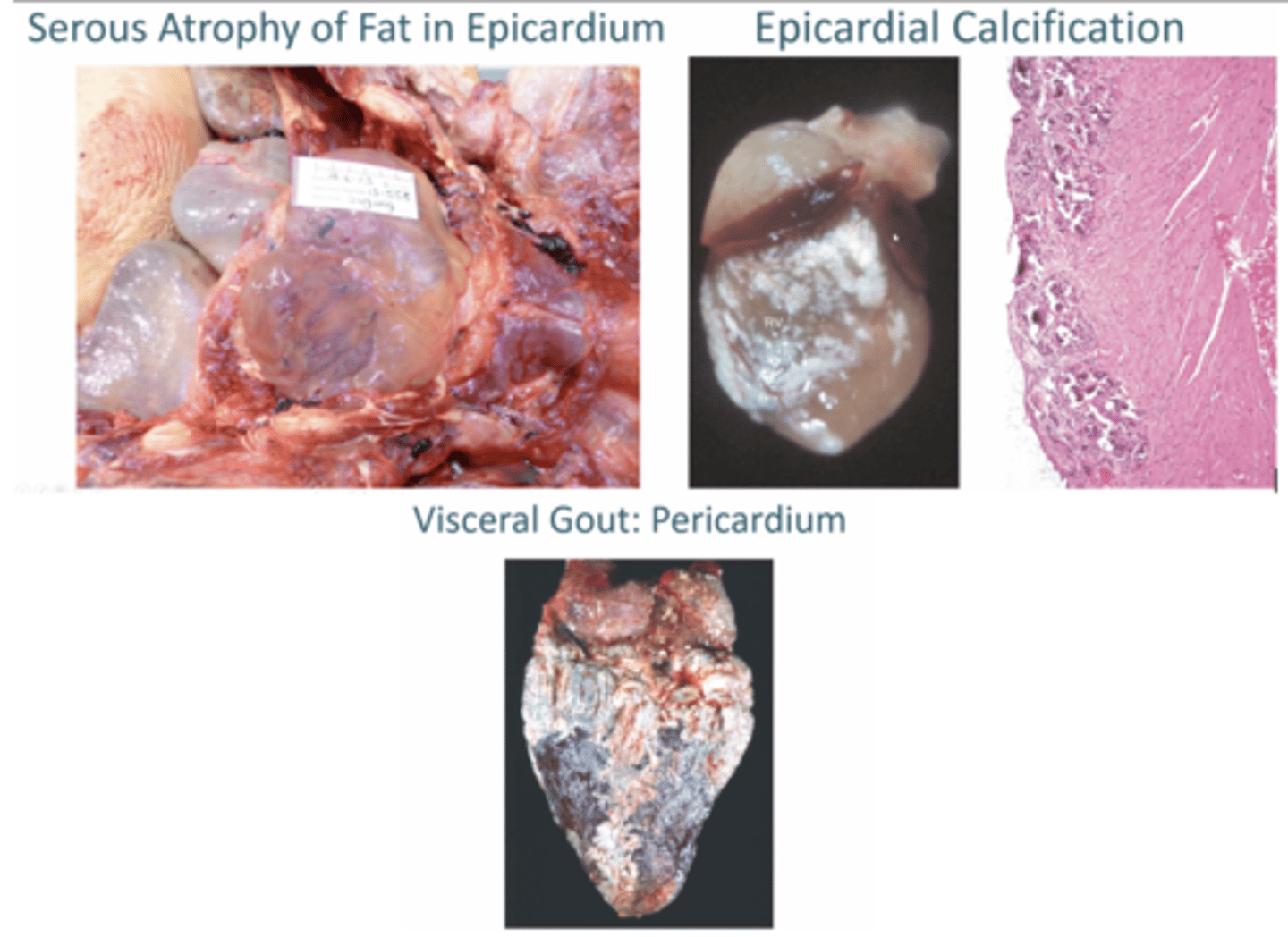 <p>1. Gelatinous pale epicardial fat (Caused by anorexia, starvation, cachexia</p><p>2. Dystrophic calcification, Inherited in some mice</p><p>3. Uric acid crystals in birds + reptiles </p>