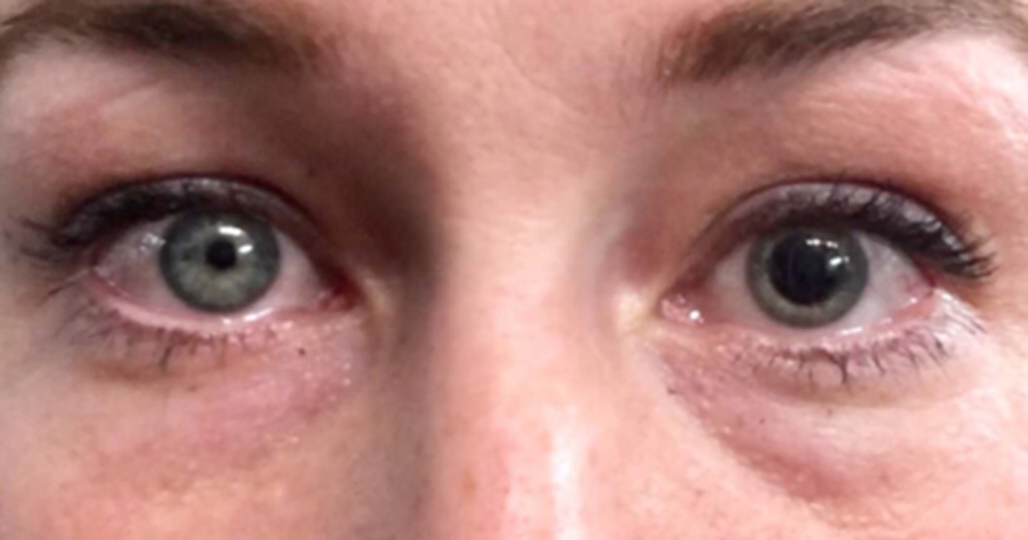 <p>indirect APD test to confirm no afferent problem with CN II</p><p>eyelid function to confirm no ptosis</p><p>EOM to confirm no palsy</p><p>ask about chemicals that could have entered the eyes</p><p>pharmacolgoical supersensitivity test would be okay to do</p>
