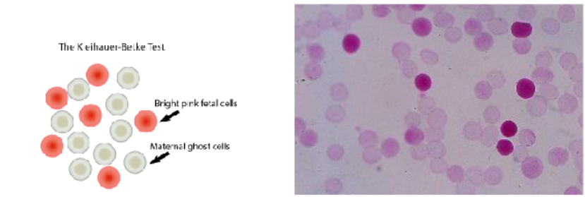 <ul><li><p><span>Quantitates fetal cells in the maternal circulation by using a blood smear made from blood drawn from the mother</span></p></li><li><p><span>Smear is placed in an acid buffer</span></p><ul><li><p><span>Hemoglobin in adult RBCs (Hgb A) leaches out of the cells into the buffer</span></p></li><li><p><span>Fetal Hgb (Hgb F) is resistant to the acid and will stay within the RBC</span></p></li></ul></li><li><p><span>Smear is washed, stained with Wright stain, and examined microscopically under oil immersion (1000x)</span></p></li><li><p><span>Adult RBCs will look "ghostlike" because only the cell membrane remains, and the fetal cells will stain pink</span></p></li></ul><p></p>