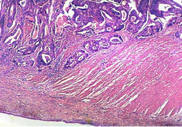 Adenocarcinoma