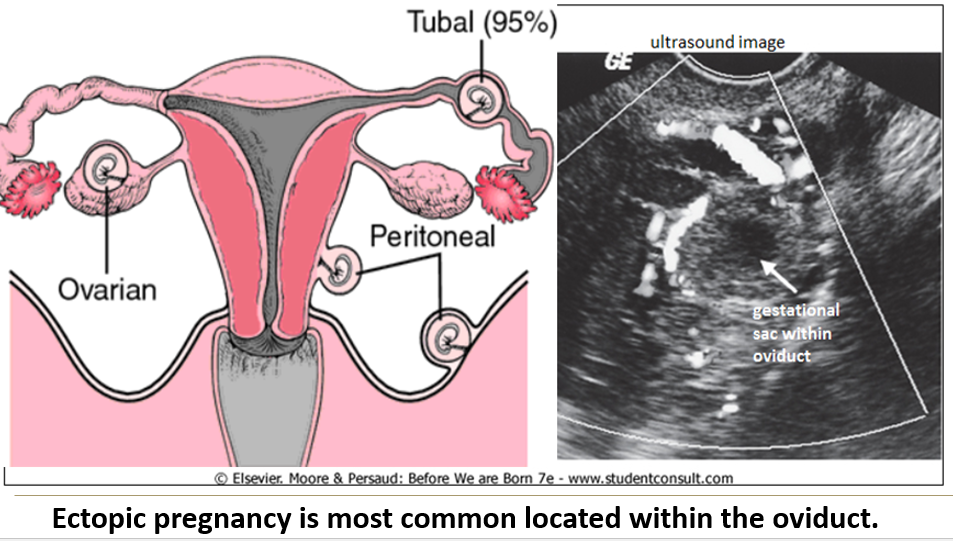 <p>It’s when an <strong>embryo implants outside the uterus</strong>, most commonly in the <strong>oviduct</strong>, causing <strong>abdominal pain</strong> early in pregnancy.</p>