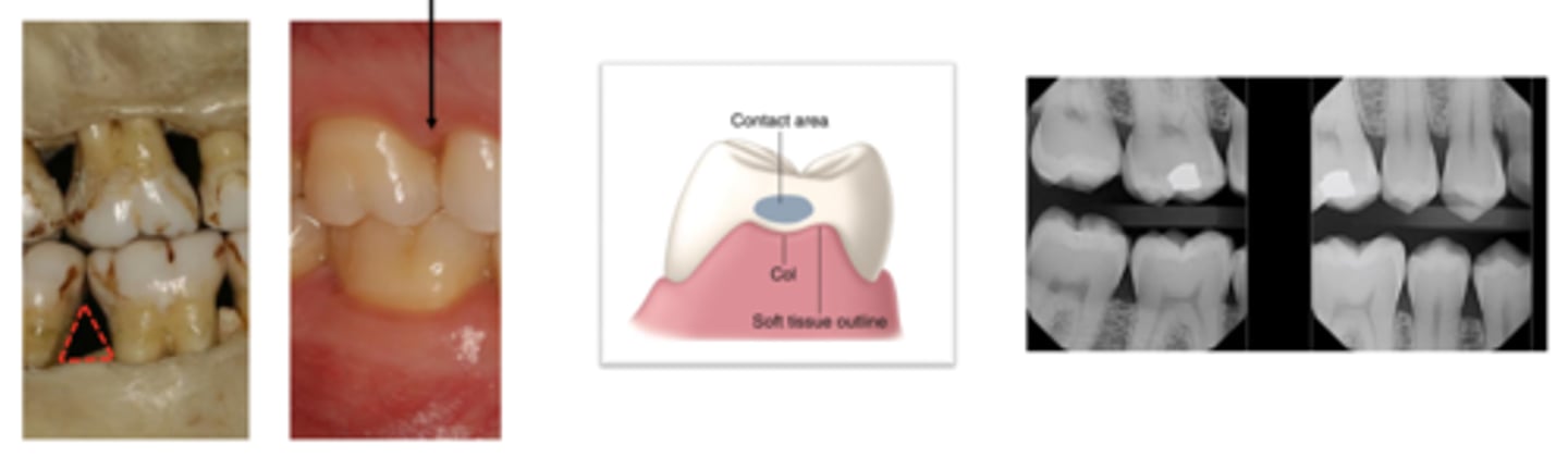 <p>The interproximal space is a triangle space filled with the...</p>