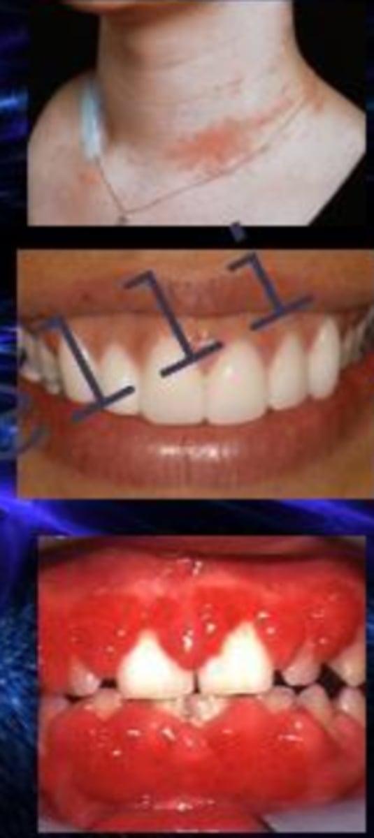 <p>nickel allergies are more common in _______ and can be caused from chronic exposure through jewelry and can be quite severe</p>