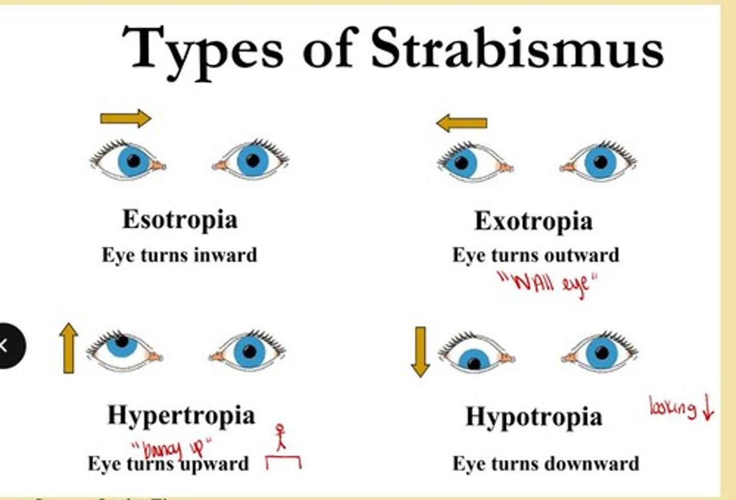 <p>Myopia (near-sightedness), hyperopia (far-sightedness), astigmatism.</p>