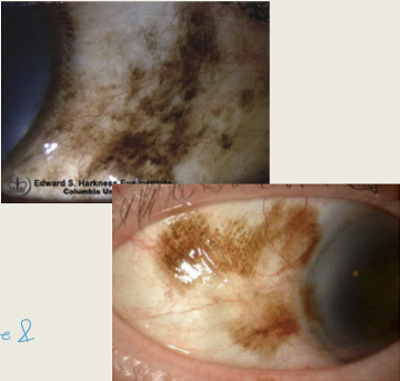 <ul><li><p>PAM without atypia: Pigmentation of the conj epithelium with or without benign melanocyte hyperplasia; does not progress to melanoma.</p></li><li><p>PAM with atypia: Pigmentation of conj epithelium with atypical melanocyte hyperplasia; considered precancerous, high risk for melanoma.</p></li></ul><p>Need biopsy to differentiate </p><p></p>