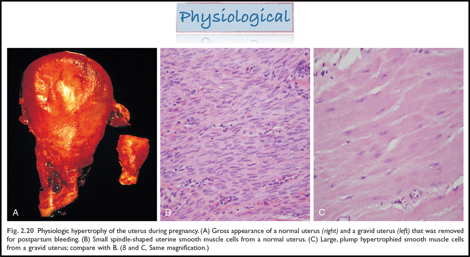 <ul><li><p>there is physiological hypertrophy of the uterus during pregnancy</p></li><li><p>left ventricular hypertrophy also occurs </p></li></ul><p></p>