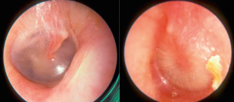 <p>A 10-year-old male presents to the office with fever, unilateral ear pain and diminished hearing. Otoscopic examination reveals the result shown in the accompanying figure.</p><p>i. The Weber test will most likely be localized to the:</p><p>A. left ear</p><p>B. right ear</p><p>C. midline</p><p>ii. The Rinne test, on the left side, will most likely reveal:</p><p>A. A &gt; B</p><p>B. A &lt; B</p><p>C. Deafness</p><p>iii. The boy has:</p><p>A. Otitis externa and conductive hearing loss</p><p>B. Otitis externa and sensorineuronal hearing loss</p><p>C. Otitis media and conductive hearing loss</p><p>D. Otitis media and sensorineuronal hearing loss</p><p>E. Presbycusis and conductive hearing loss</p><p>F. Presbycusis and sensorineuronal hearing loss</p><p>G. Tinnitus and conductive hearing loss</p><p>H. Tinnitus and sensorineuronal hearing loss</p>