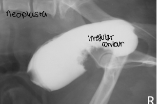 <p>position and wall integrity </p>