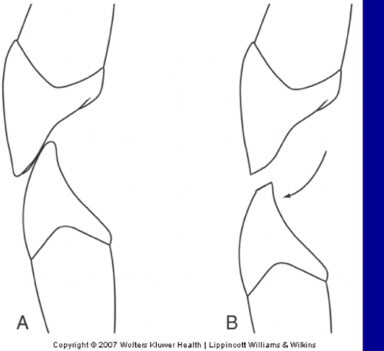 <p>Flattened plane produced by wear on convex area of tooth surface and occurs at contact areas</p>