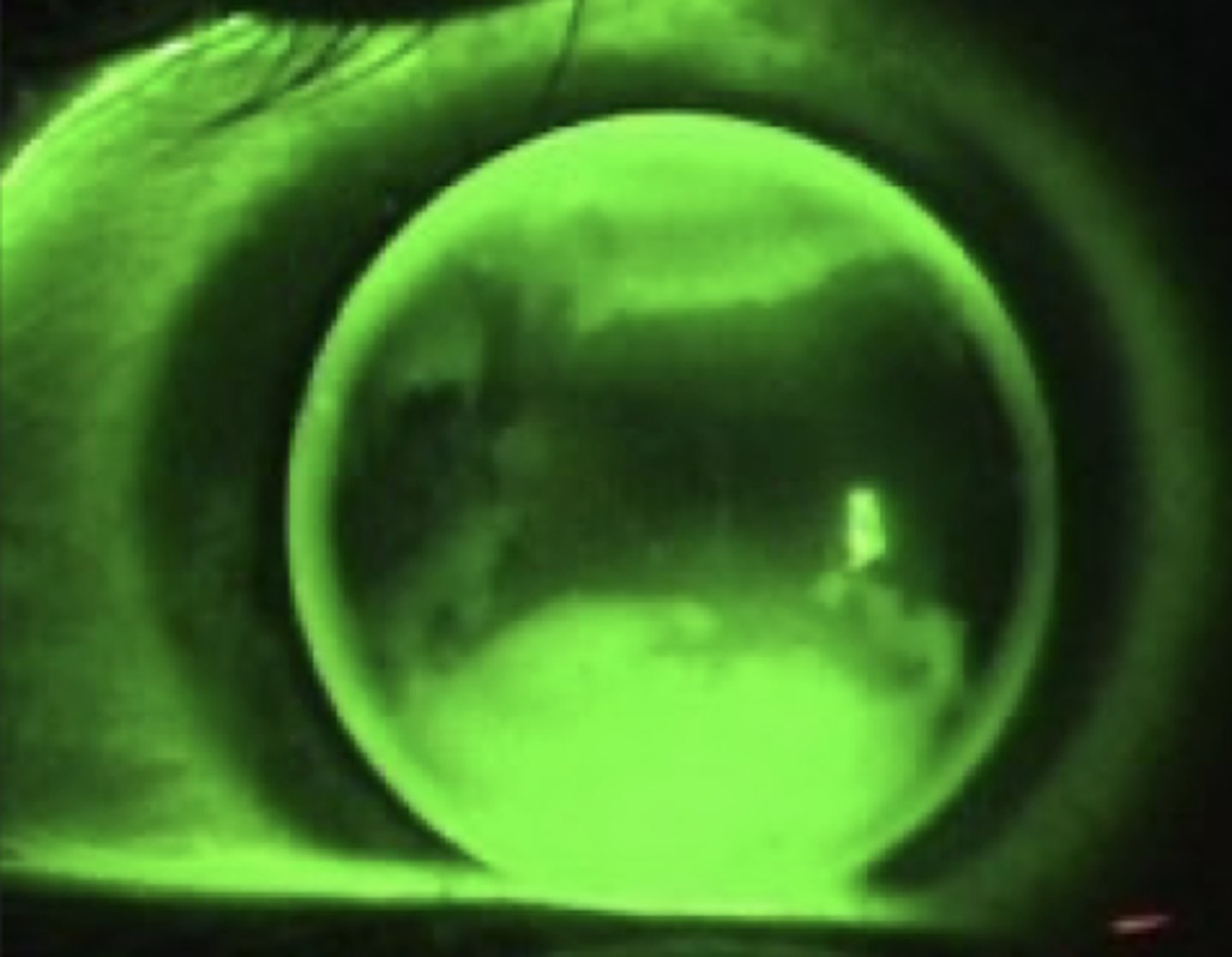<p>what astigmatism fluorescein pattern</p>