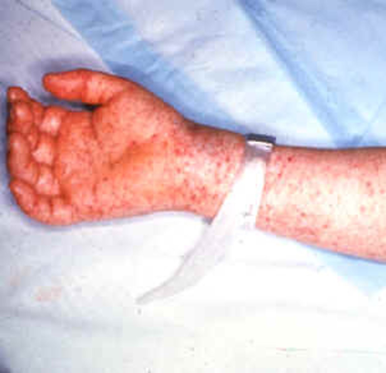 <p>-macular/petechial rash on PALMS AND SOLES</p>