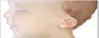 <p>May indicate down syndrome</p><p>Lower pinna than lateral canthus</p>