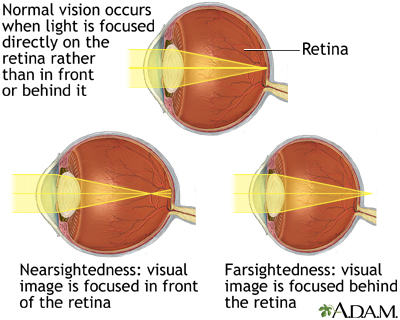 <p><strong><u>Vision (mod 18)</u></strong></p><p>Near-sighted, can see near but has trouble seeing farther in the distance. Caused by elongated eyeballs.</p>