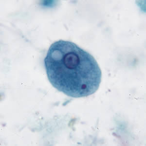 <ul><li><p>15-50 um</p></li><li><p>large, eccentric karyosome</p></li><li><p>uneven chromatin</p></li><li><p>“dirty” vacuolated cytoplasm</p></li><li><p>bacteria in cytoplasm</p></li></ul><p></p>