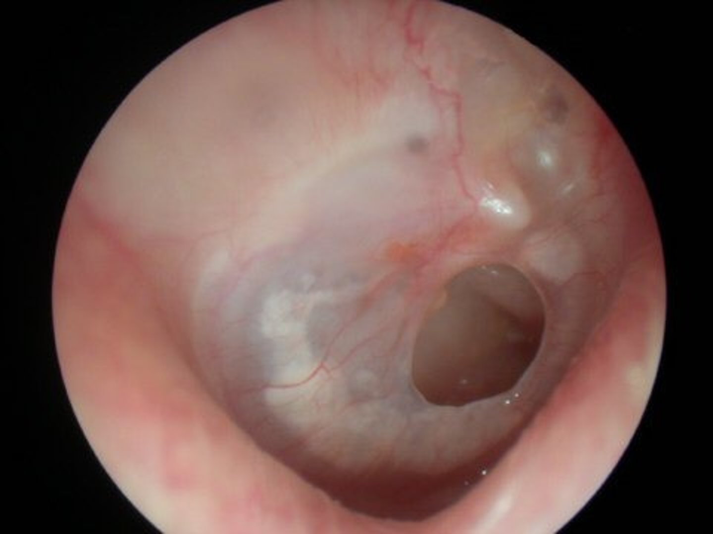 <p>Holes in eardrum from:</p><p>Infection</p><p>Trauma</p><p>~</p><p>Classed as:</p><p>Central</p><p>Marginal</p><p>~</p><p>Scarring causes loss of landmarks</p><p>Heals in tympanosclerosis</p>