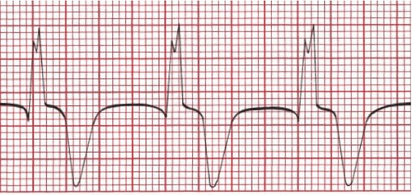 <p>same characteristics as ventricular escape rhythm</p><p>RATE = 40-100 bpm</p>