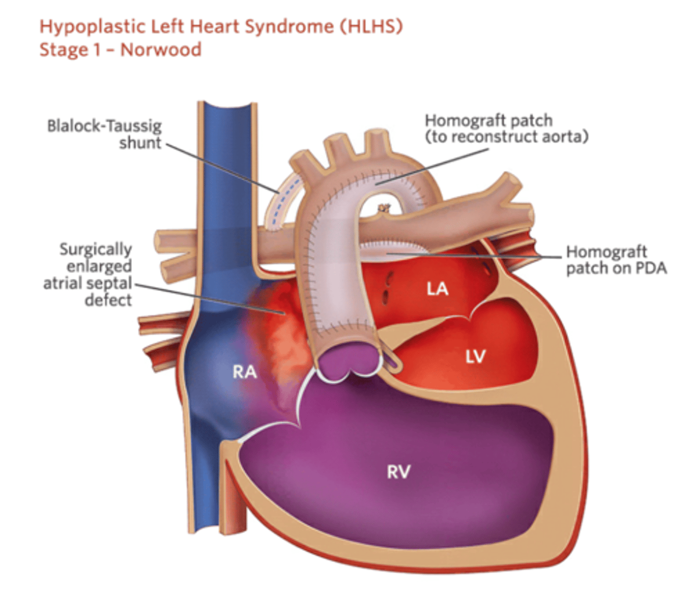 <p>Sano had lower mortality right after but higher need for interventions and complications particularly increased need for pulmonary artery reinterventions. </p><p>Sano had higher transplant free survival at 1 year vs MBTS (74% vs 64%). </p><p>interstage mortality after doing one or the other was the same. </p><p>hazards of death or transplant or catheter interventions was the same at 6 years between the two.</p>