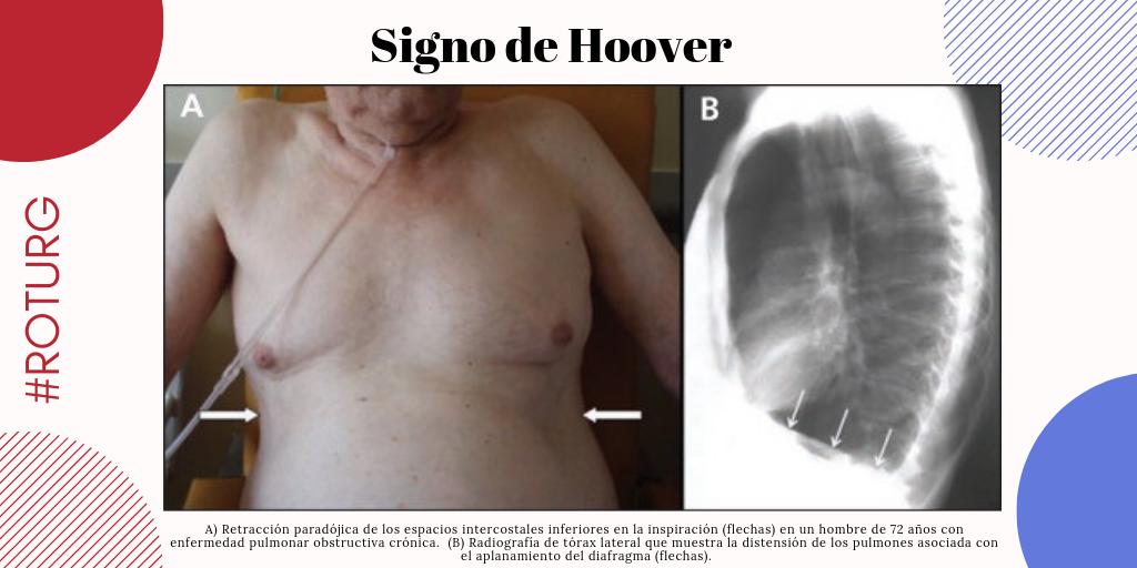 <p>Es un movimiento paradójico de la parte inferior de la caja torácica durante la inspiración (se mete hacia adentro en lugar de expandirse). Ocurre en condiciones de <strong>hiperinsuflación pulmonar</strong> (como en el EPOC), porque el diafragma está aplanado y pierde su ventaja mecánica.</p>