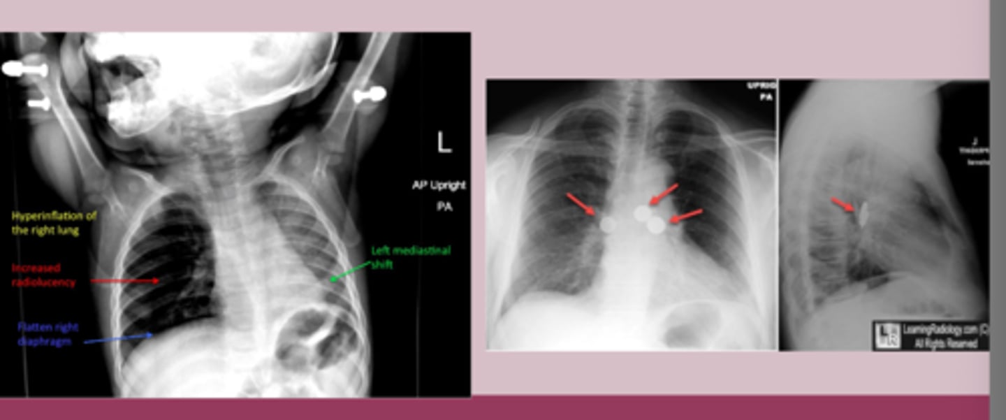 <p>-witness choking episode, sudden onset sx </p><p>-unilateral wheeze</p><p>-CXR: object is visible, hyperinflation, left mediastinal shift, atelectasis, air trapping </p><p>-CT chest: more sensitive </p><p>-flexical bronchoscope= diagnostic </p>