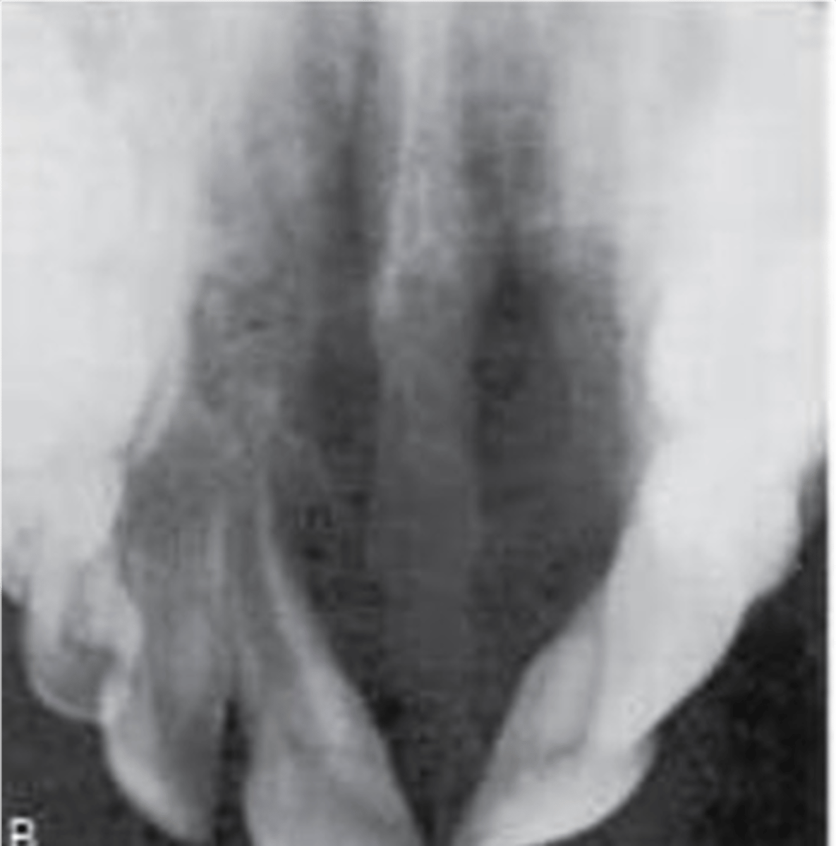 <p>Non-neoplastic bone growth. Etiology unknown. Most commonly seen in females 30 years and younger. Treatment based on level of destruction. Corticosteroid injections reverse some CGCGs.</p>