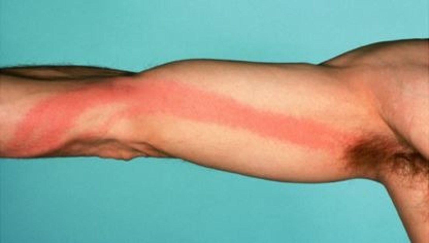 <p>inflammation of lymph vessels</p>
