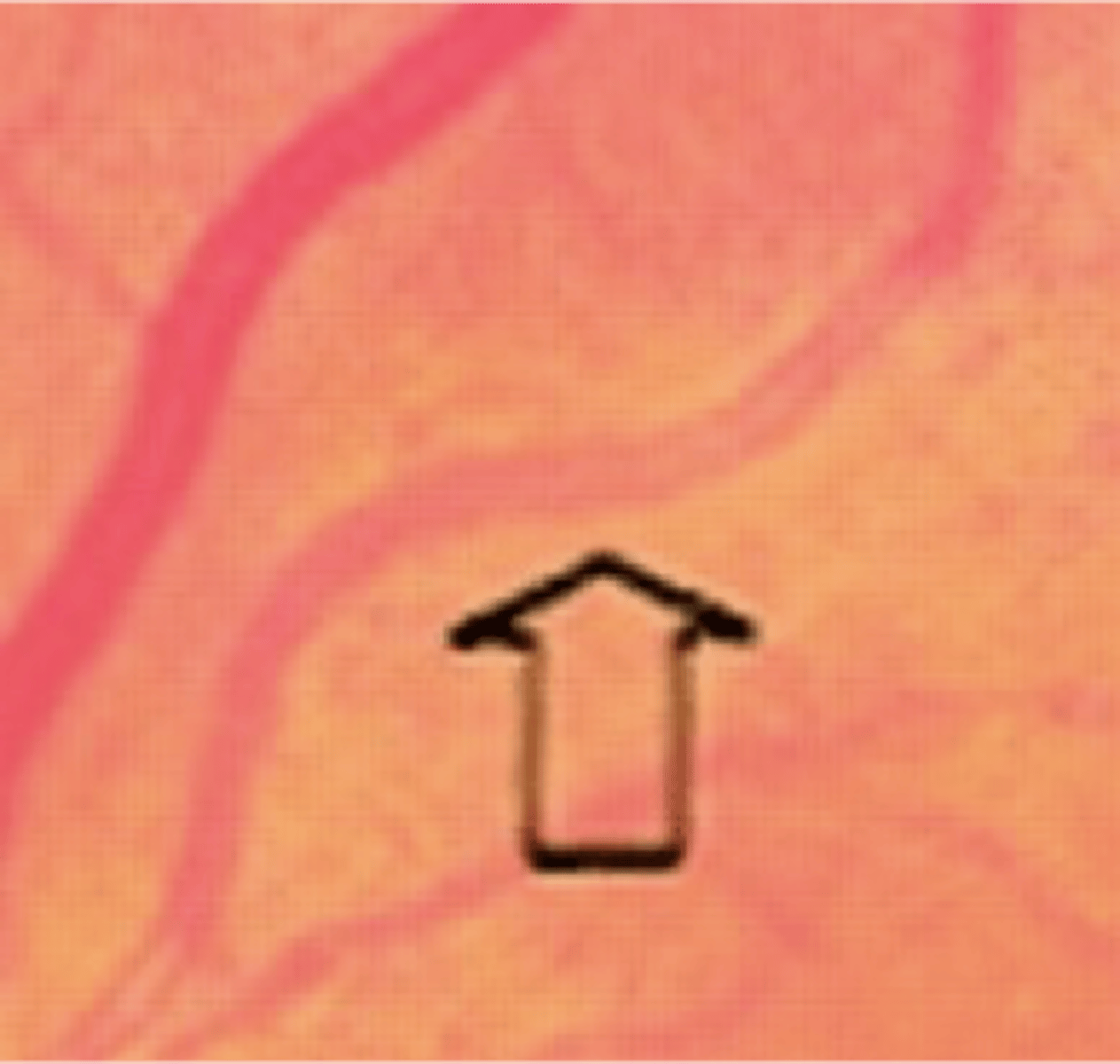 <p>ID - usually found in conjunction with HTN but may be present with hyper cholesterolemia with infiltration of lipids into the vessel in the elderly</p>