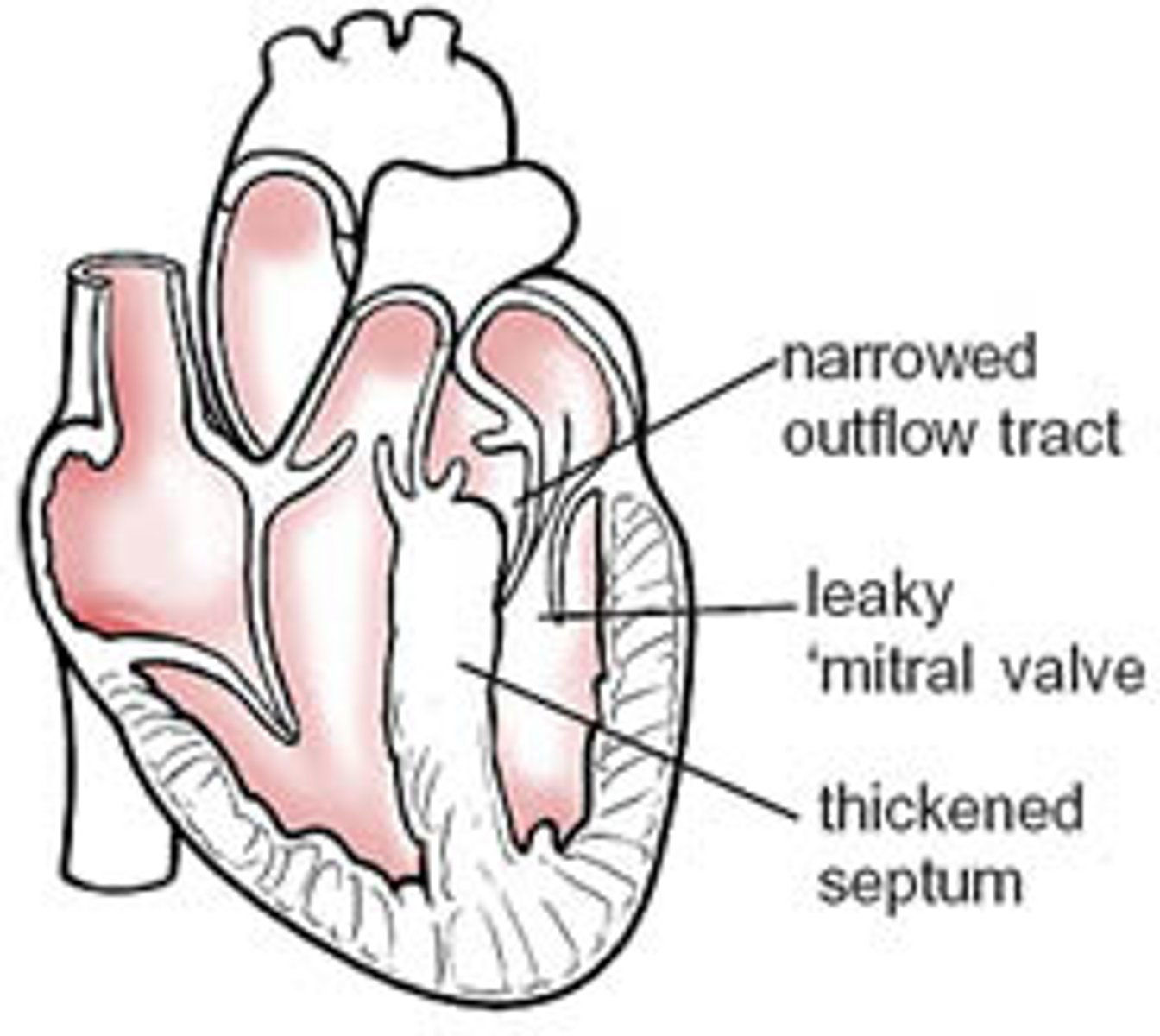 <p>- thickening of the septal wall</p><p>- most common inherited heart defect</p>