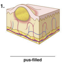 <p><span style="color: red">F Match each of the following lesions with their illustrations in Figure 16-26.</span><br></p>