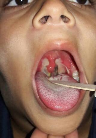 Diphtheria
