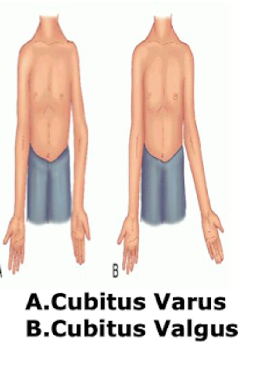 <p>Larger → cubitus varus ("bowed")</p><p>Smaller → cubitus valgus ("knocked")</p>