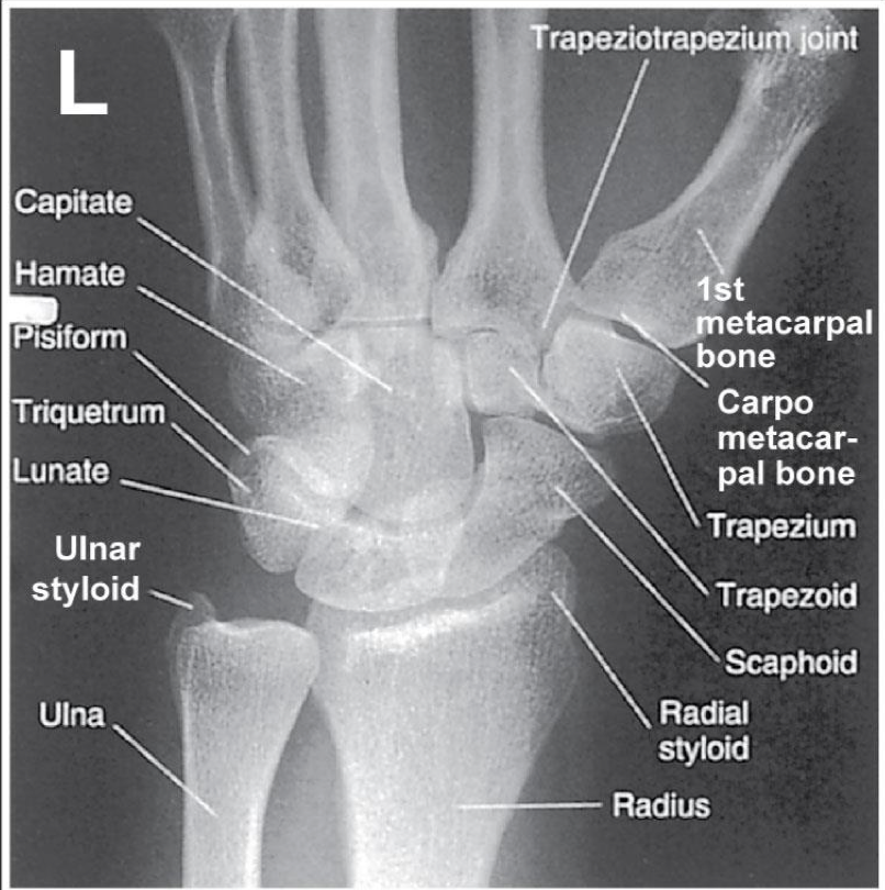 <p><span style="line-height: normal;">• </span>Distal radius, ulna, and carpals demonstrated</p><p class="p1"><span style="line-height: normal;">• </span>Radius &amp; ulna partially superimposed</p><ul><li><p class="p1">slight overlap of metacarpals</p></li></ul><p class="p1"><span style="line-height: normal;">• </span>Center of field at midcarpals</p><p class="p1"><span style="line-height: normal;">• </span>Trapezium and trapezoid seen in its entirety</p><p class="p1"><span style="line-height: normal;">• </span>Scaphoid is minimally superimposed by trapezoid &amp; capitate</p><p class="p1"><span style="line-height: normal;">• </span>Exposure factors: soft tissue + bony detail</p><p class="p1"></p><ul><li><p class="p1">3rd metacarpal lines up with middle of wrist</p></li></ul><p></p>
