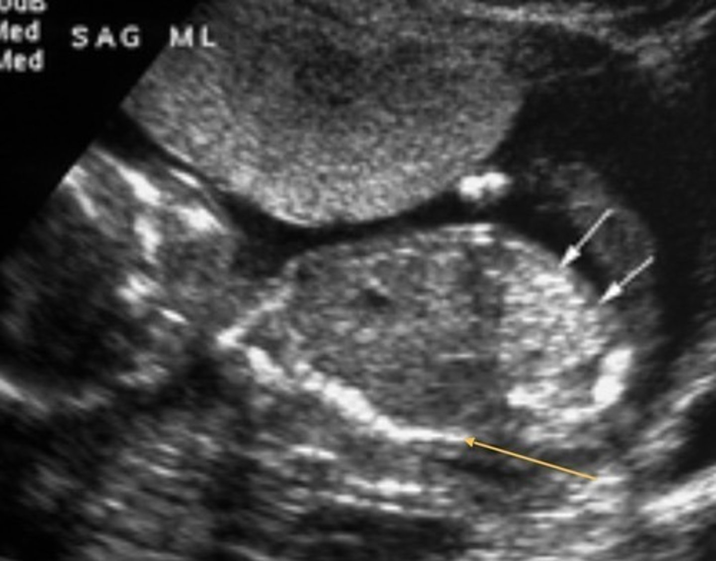 <p>Bowel as bright as bone</p>