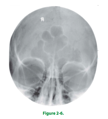 (C) Erect PA, chin extended, OML 15° from horizontal