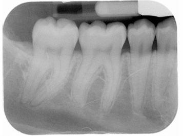<p>How would you resolve this Underexposed Receptor X-ray?</p>