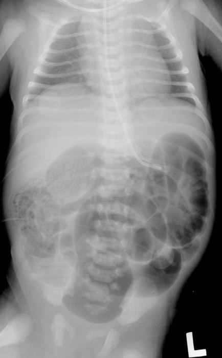 <p>What other names are used for imperforate anus?</p>