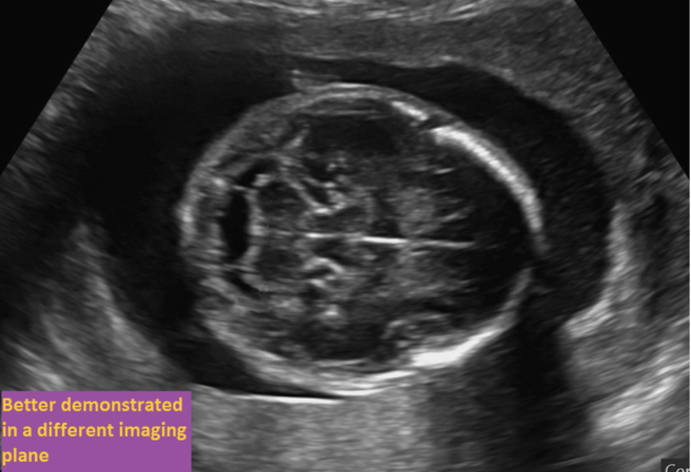 <p>where is the choroid plexus</p><ul><li><p>“imaged better in a different plane”</p></li><li><p>axial plane superior to this one</p></li></ul><p></p>