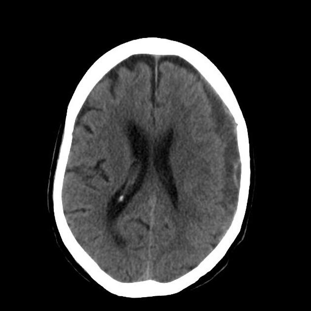 <p>Subdural Haematoma - Blood accumulates between the dura and arachnoid mater of the meninges, bleeding in the ventricles and causes a midline shift </p>