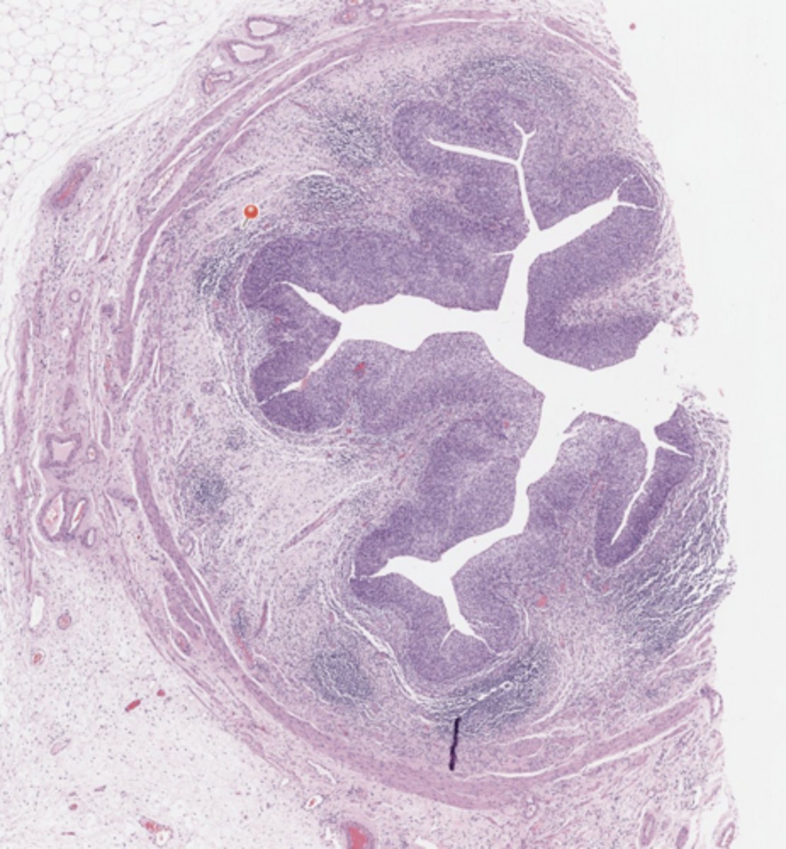<p>Urothelial tract</p>