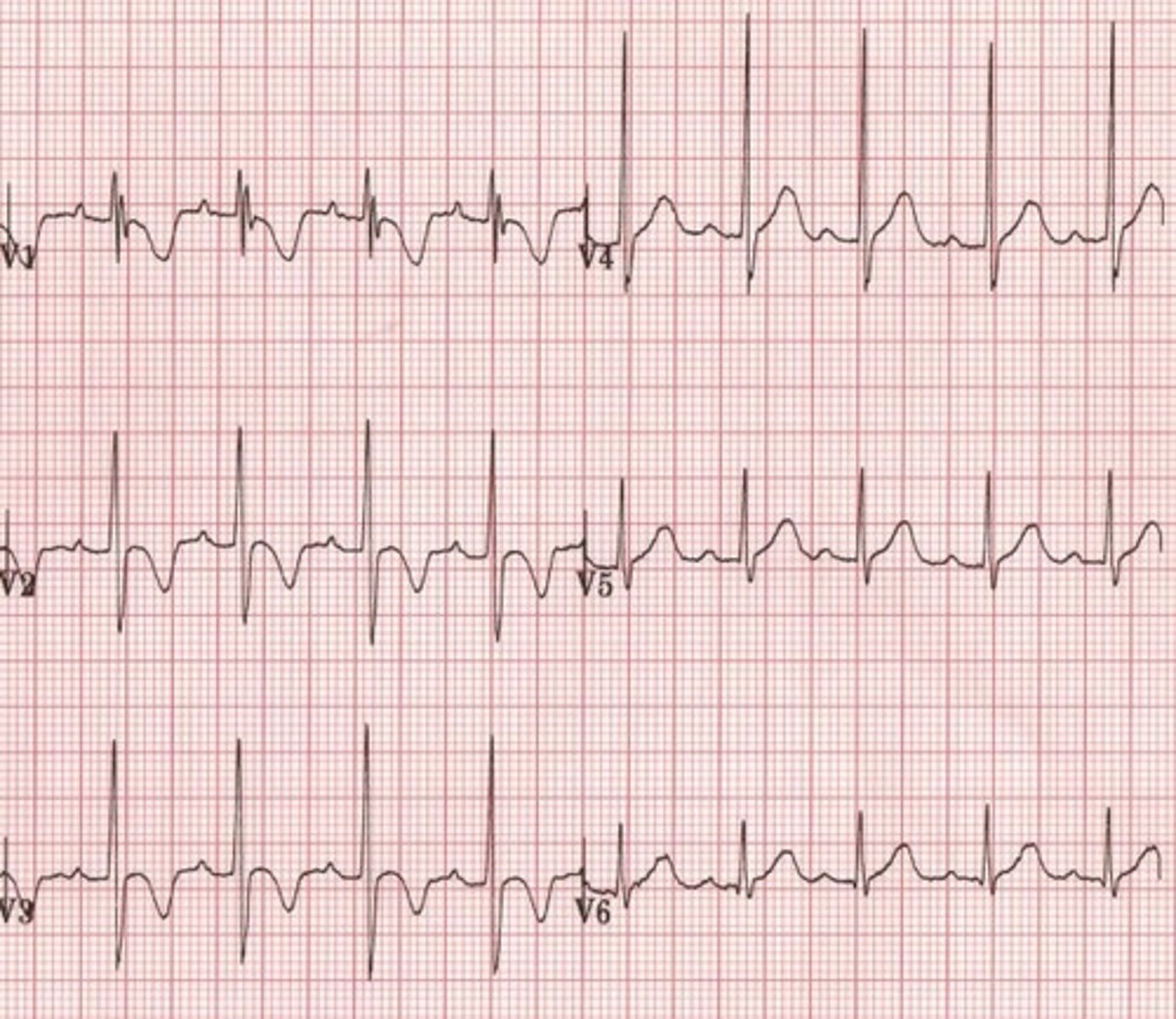 <p>- children have asymmetric T wave inversions through right chest leads</p><p>- can persist in adults, particularly African-American women under the age of 30</p>