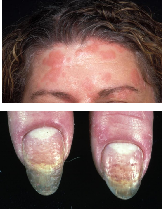 <ul><li><p>The scalp and hairline are frequently affected</p></li><li><p>Nail <u>p</u>itting and <strong>subungual hyperkeratosis</strong> is sometimes present → due to plaques under the nails </p></li></ul><p></p>