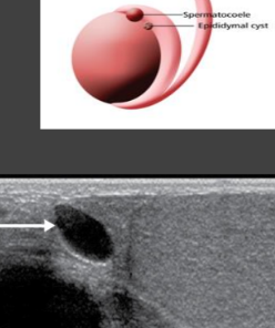 <p>epididymal cysts</p>