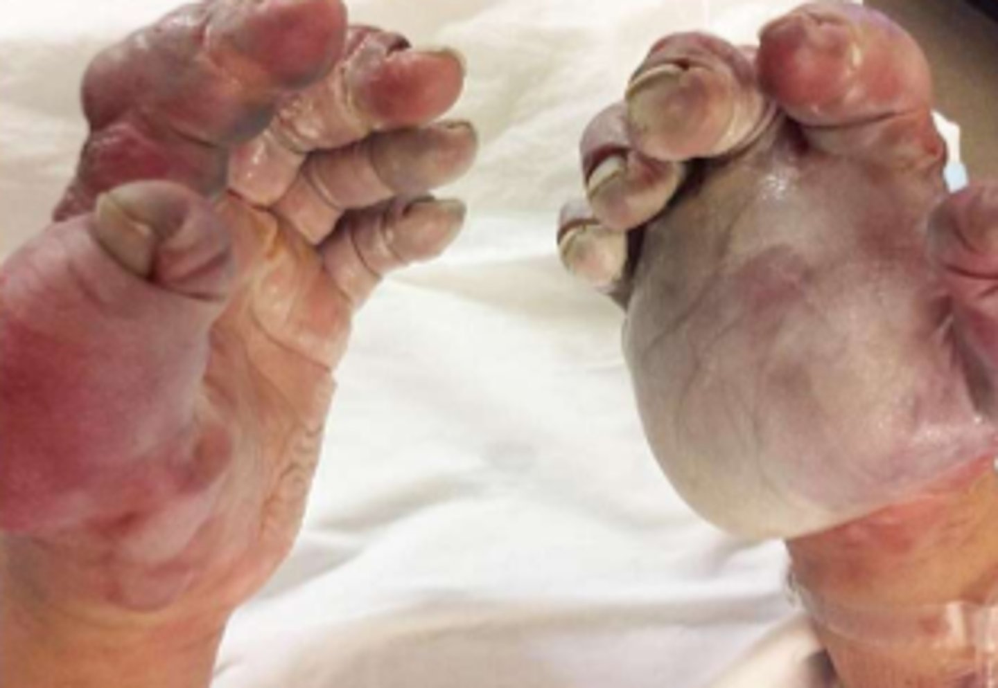 <p>* result of an initial extracellular freezing injury followed by a reperfusion injury due to vasoconstriction and microthrombosis in affected tissues</p>