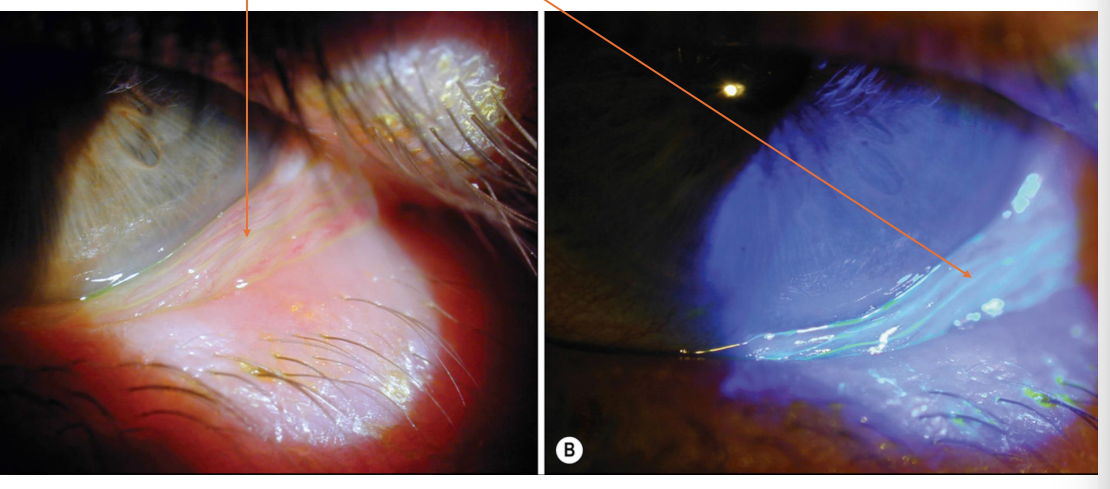 <p>• Bilateral condition described has <strong><u>redundant, loose, non edematous bulbar conjunctiva</u></strong></p><p> • Normal aging, mechanical forces</p>