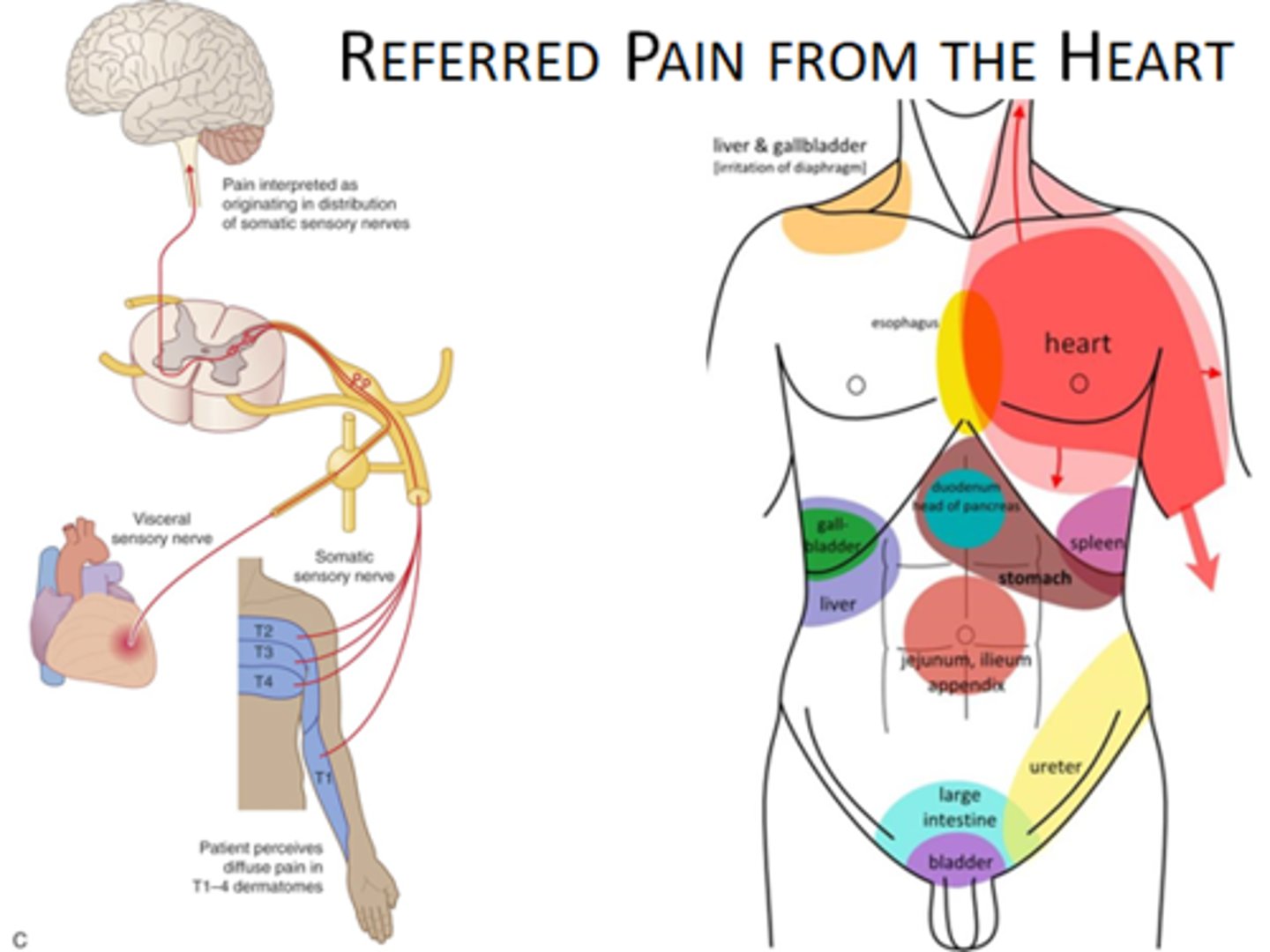 <p>Pain felt in another area of the body.</p>